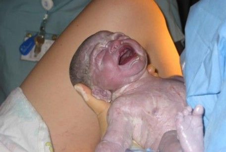 Episiotomia, quel piccolo taglio durante il parto