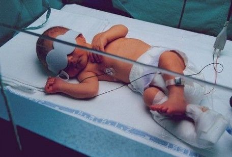 Ittero neonatale, tutto ciò che bisogna sapere