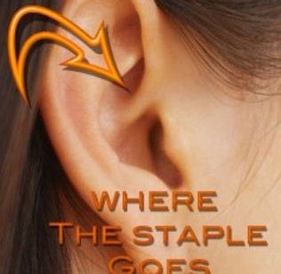 ear stapling