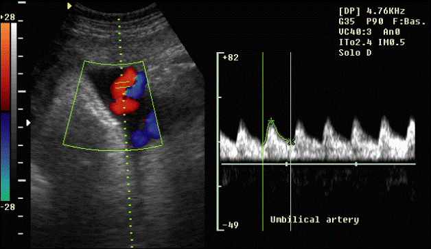 Flussimetria materno fetale