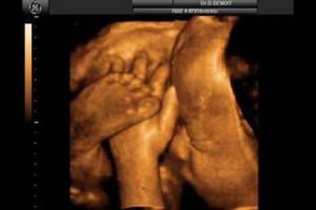 Ecografia biometria in gravidanza, quando farla e cosa verifica