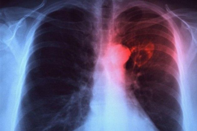 Tumore al polmone, sintomi iniziali, sopravvivenza e cure