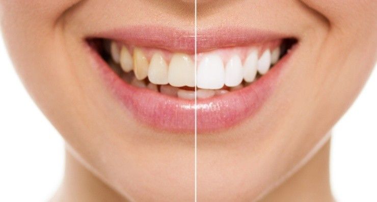 Denti più bianchi 